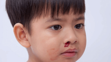 Chảy máu cam ở trẻ: Dấu hiệu cảnh báo ung thư máu
