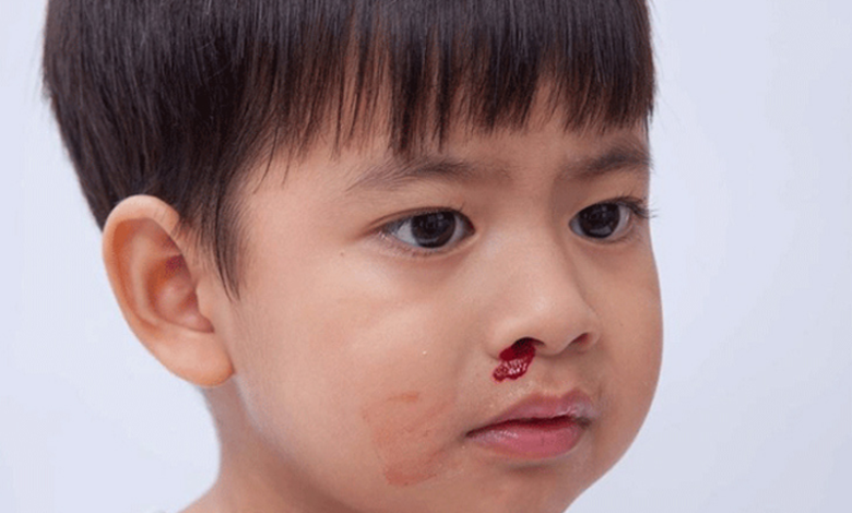 Chảy máu cam ở trẻ: Dấu hiệu cảnh báo ung thư máu