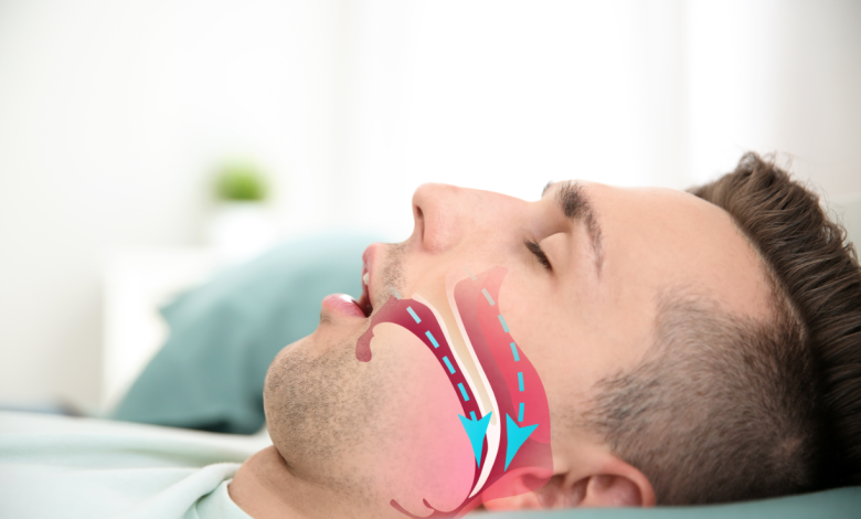 Đột quỵ do ngưng thở khi ngủ: Nguy hiểm và giải pháp điều trị