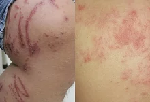 Các bệnh dễ gây nhầm lẫn với zona thần kinh