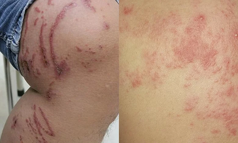 Các bệnh dễ gây nhầm lẫn với zona thần kinh